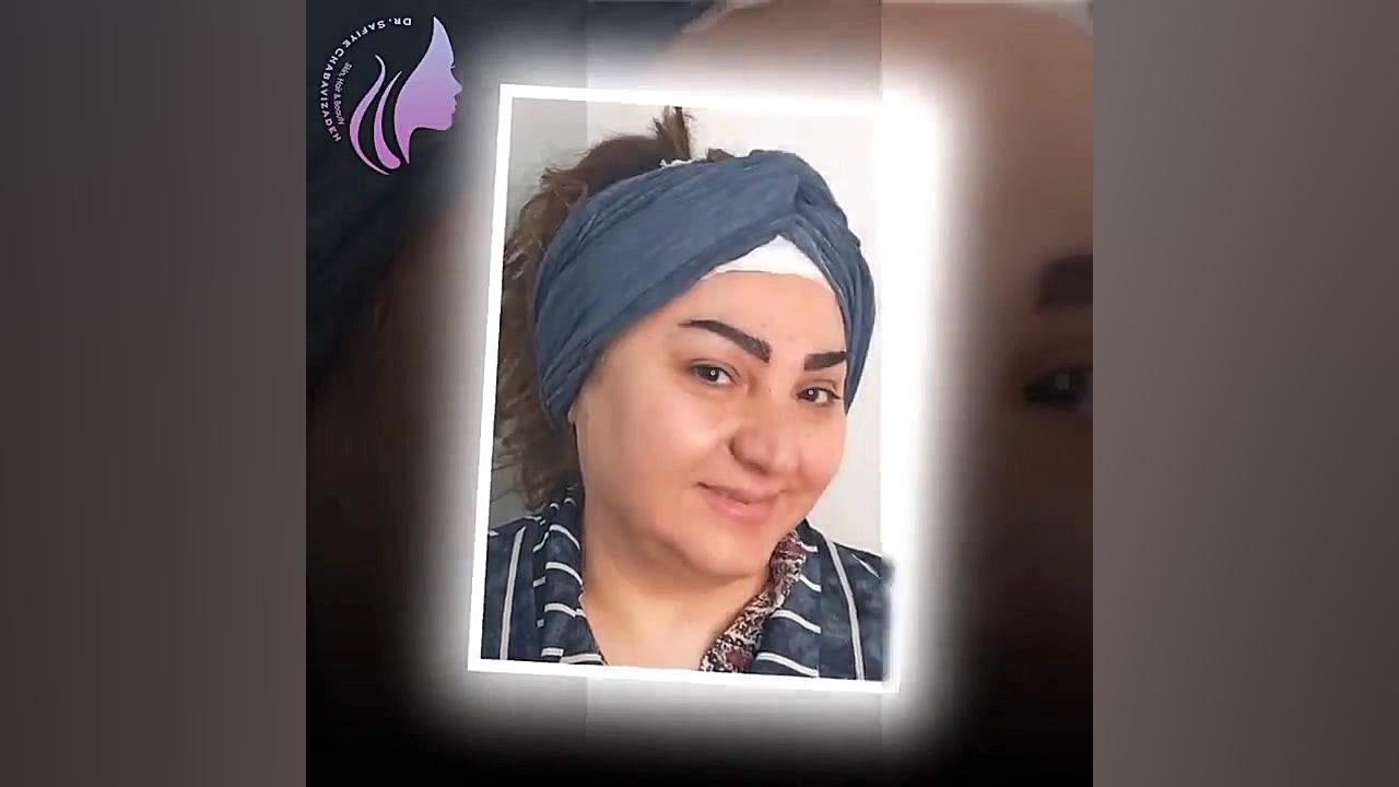 کاشت ابرو - کاور کامل تتو دکتر صفیه چعباوی زاده