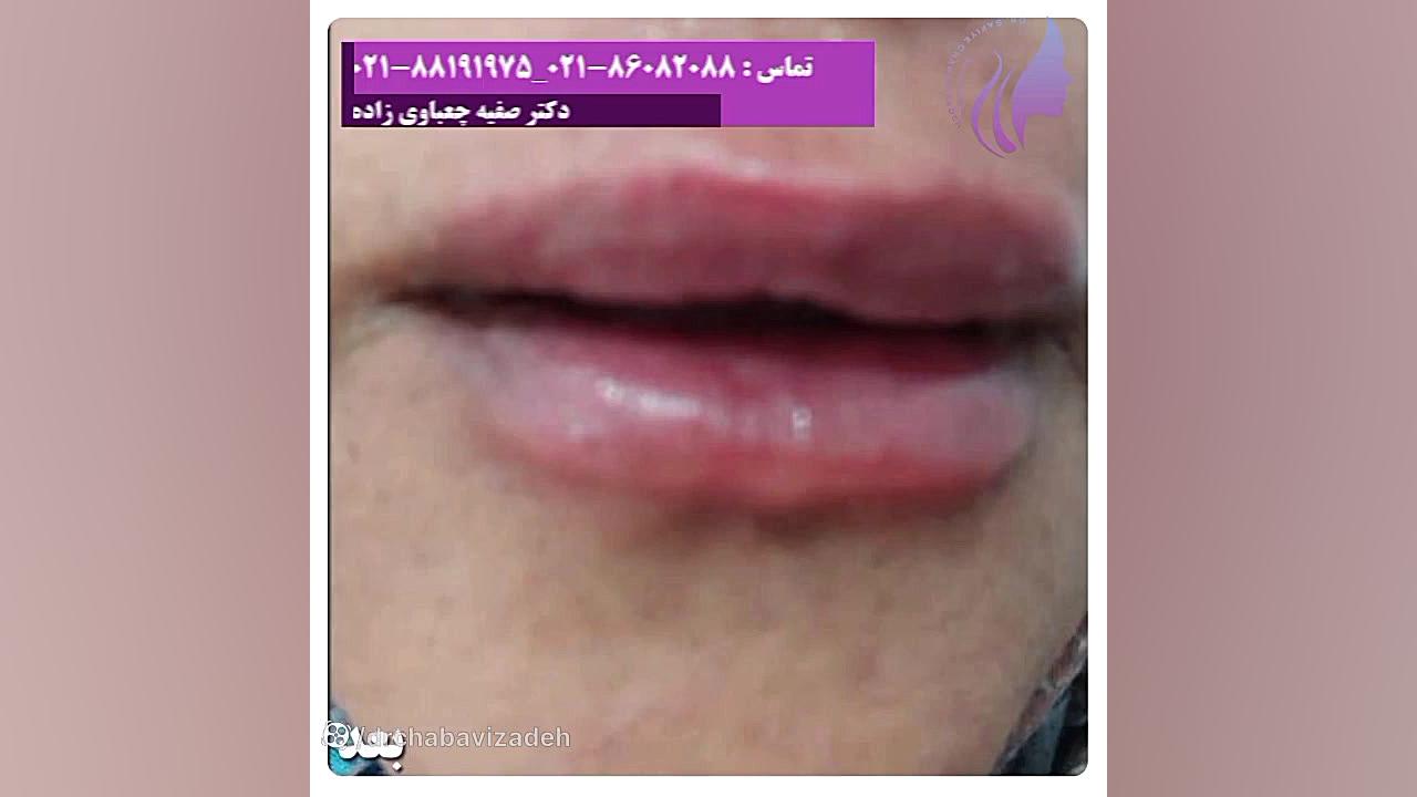 تزریق ژل لب و فرم دهی مطابق با درخواست زیباجو دکتر صفیه چعباوی زاده