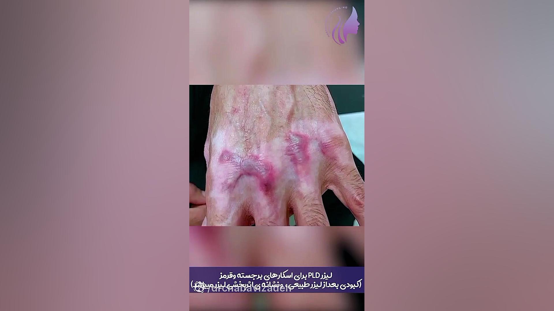 انتخاب نوع لیزر مناسب برای اسکارهای مختلف دکتر صفیه چعباوی زاده