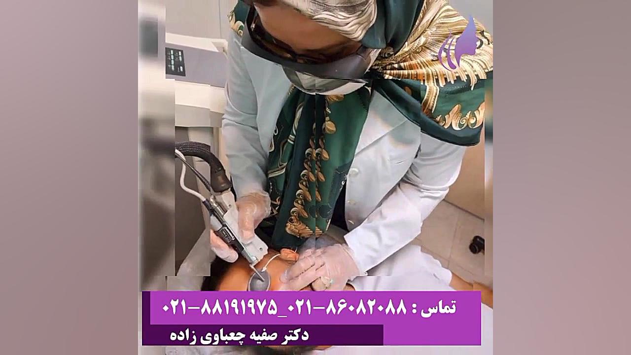 لیزر NDYAG خال عروق عنکبوتی دکتر صفیه چعباوی زاده