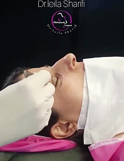 جراحی همزمان پلک و بینی - دکتر لیلا شریفی