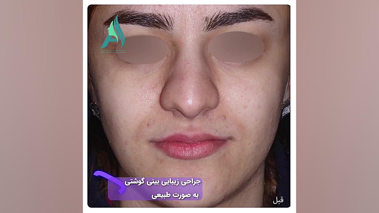 جراحی زیبایی بینی گوشتی به صورت طبیعی دکتر محمدرضا آخوندی نسب-فوق تخصص جراحی پلاستیک