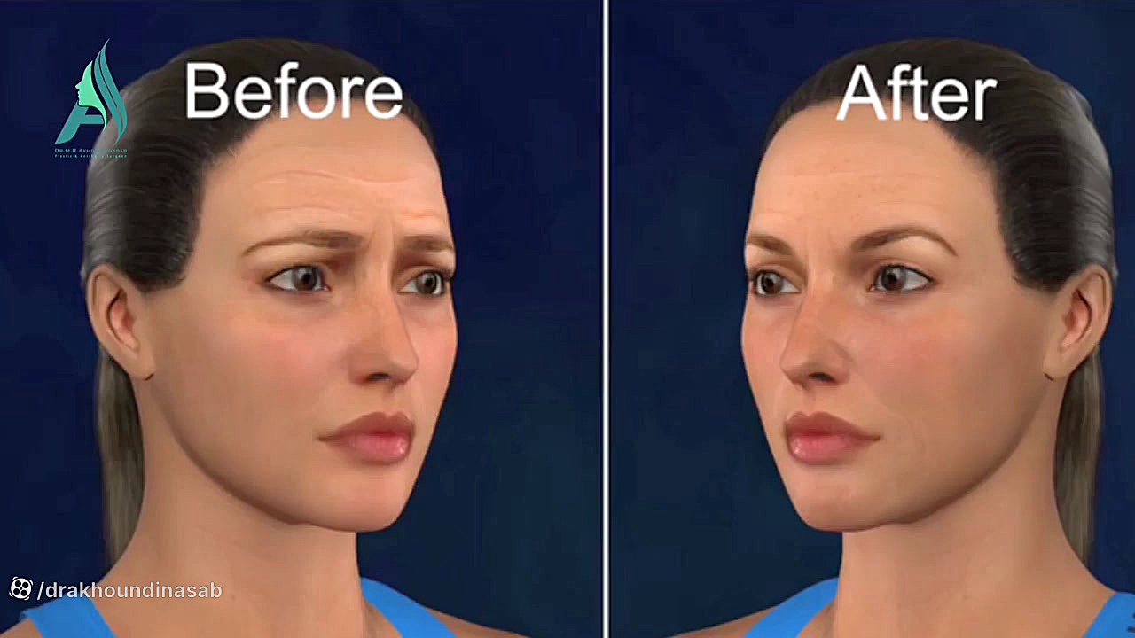 انیمیشن لیفت آندوسکوپی پیشانی دکتر محمدرضا آخوندی نسب-فوق تخصص جراحی پلاستیک