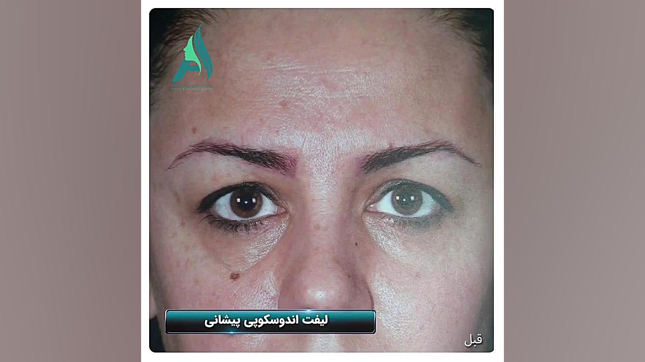 نمونه واقعی لیفت آندوسکوپی پیشانی دکتر محمدرضا آخوندی نسب-فوق تخصص جراحی پلاستیک