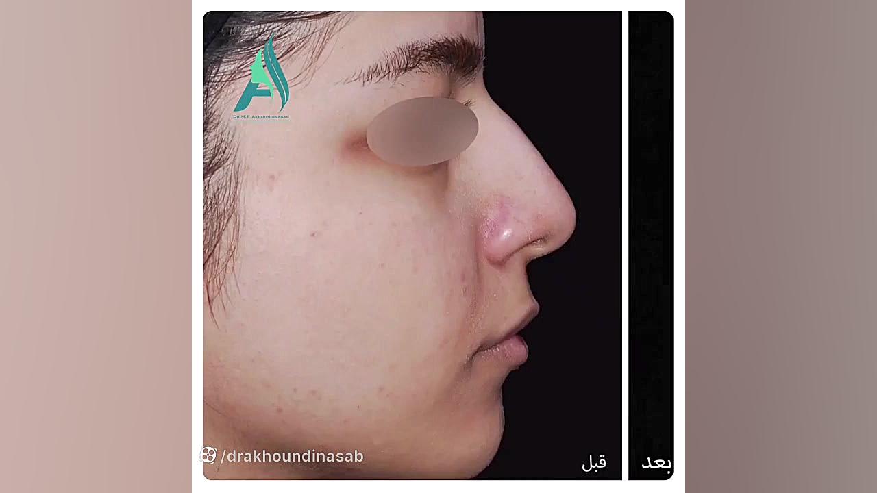 جراحی بینی گوشتی بعد از چهار سال دکتر محمدرضا آخوندی نسب-فوق تخصص جراحی پلاستیک