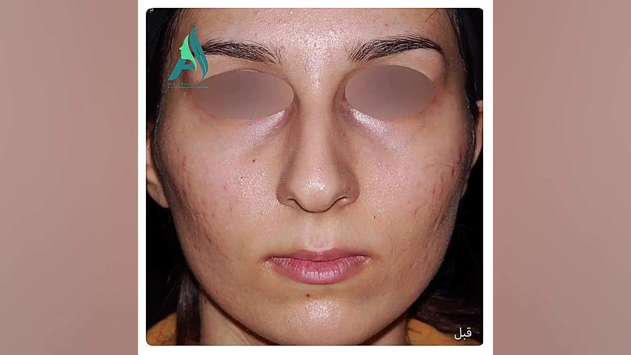 جراحی بینی استخوانی به صورت طبیعی دکتر محمدرضا آخوندی نسب-فوق تخصص جراحی پلاستیک