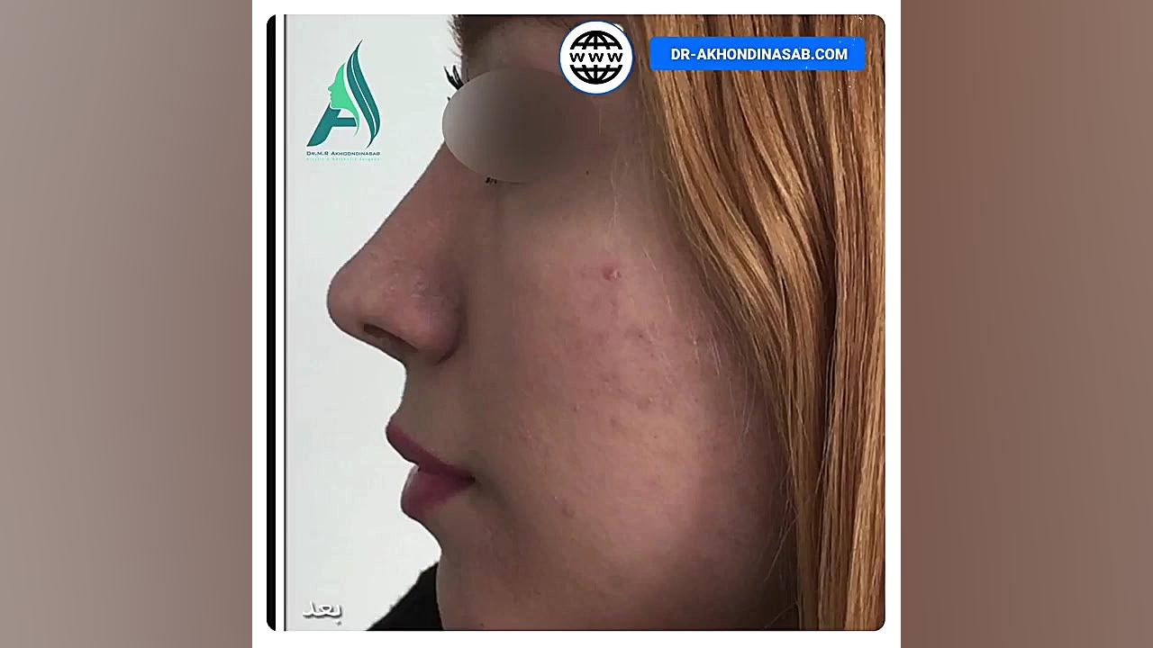 جراحی بینی استخوانی به صورت نیمه فانتزی دکتر محمدرضا آخوندی نسب-فوق تخصص جراحی پلاستیک