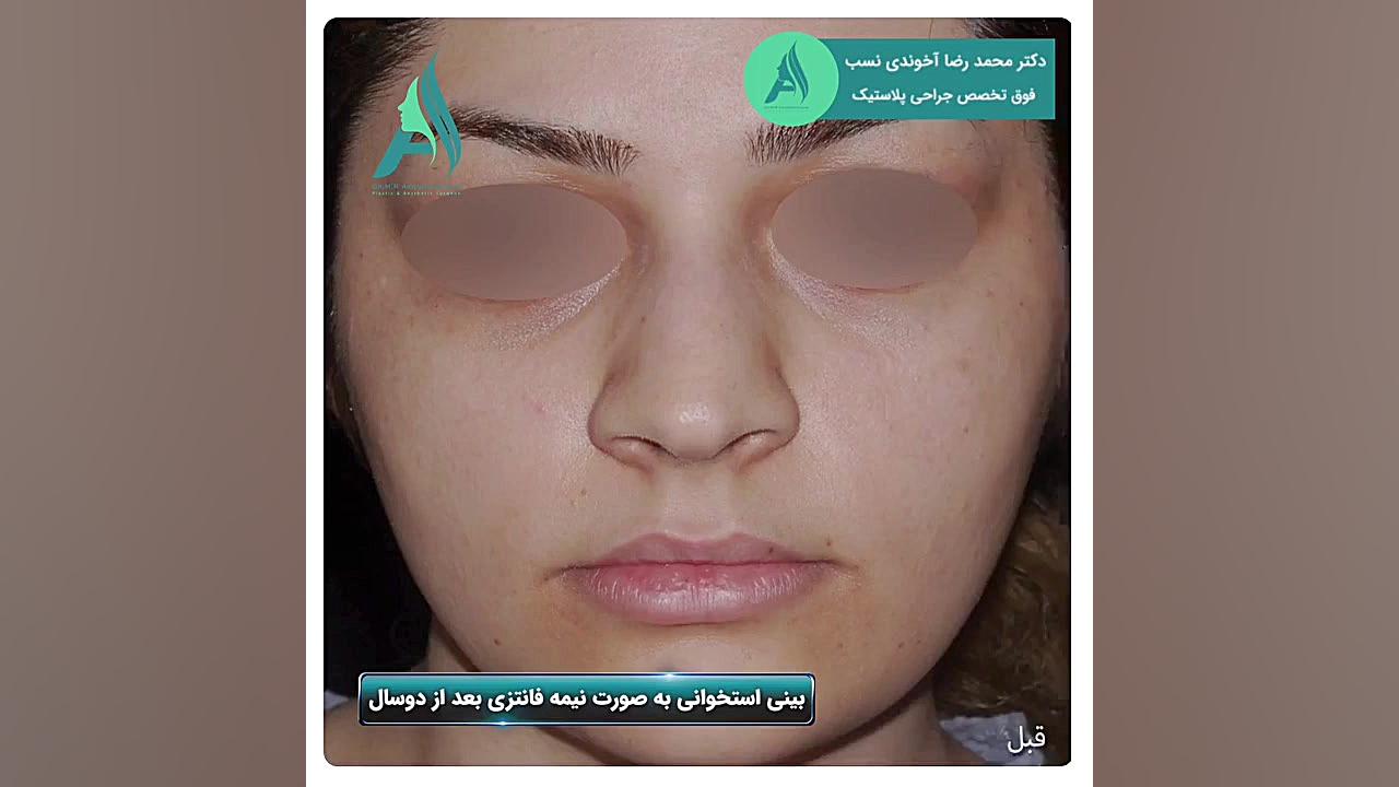 جراحی بینی استخوانی به صورت نیمه فانتزی دکتر محمدرضا آخوندی نسب-فوق تخصص جراحی پلاستیک
