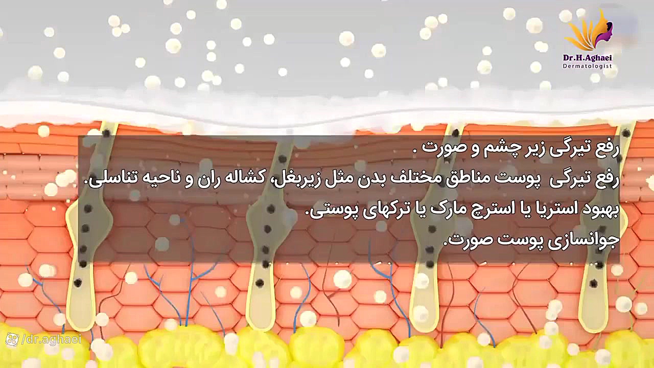 کربوکسی تراپی چیست؟ دکتر حمیده آقایی