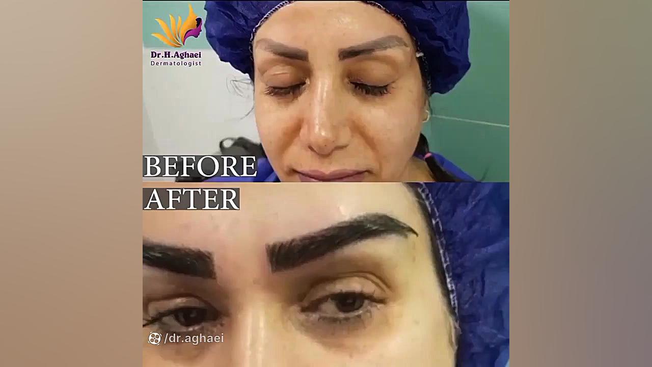 کاشت ابروی طبیعی بدون درد دکتر حمیده آقایی