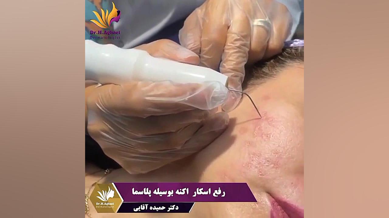 رفع اسکار اکنه به وسیله پلاسما دکتر حمیده آقایی