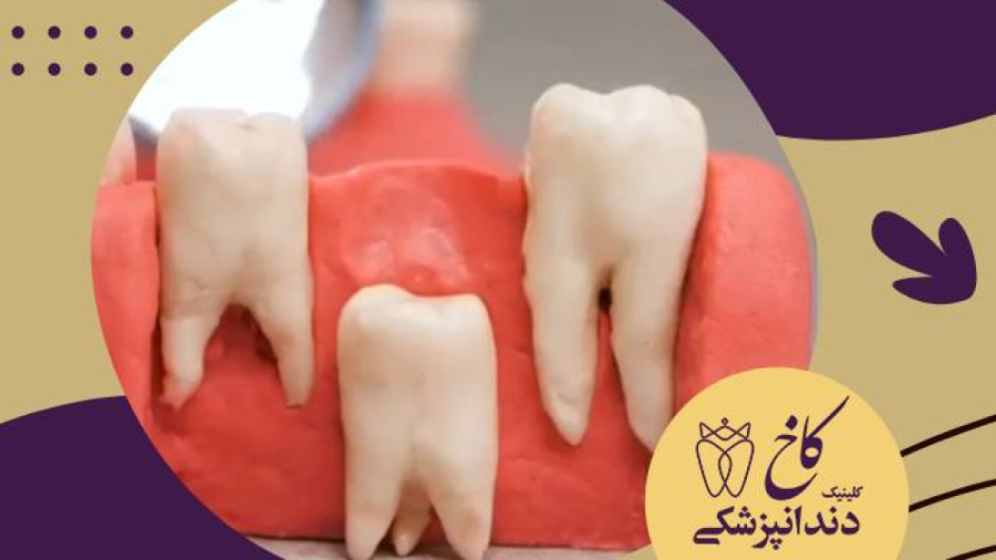 دانستنی های دندان شیری کودکان کلینیک دندانپزشکی کاخ