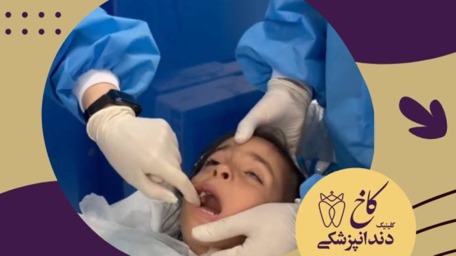 کشیدن شش دندان شیری بصورت همزمان! کلینیک دندانپزشکی کاخ