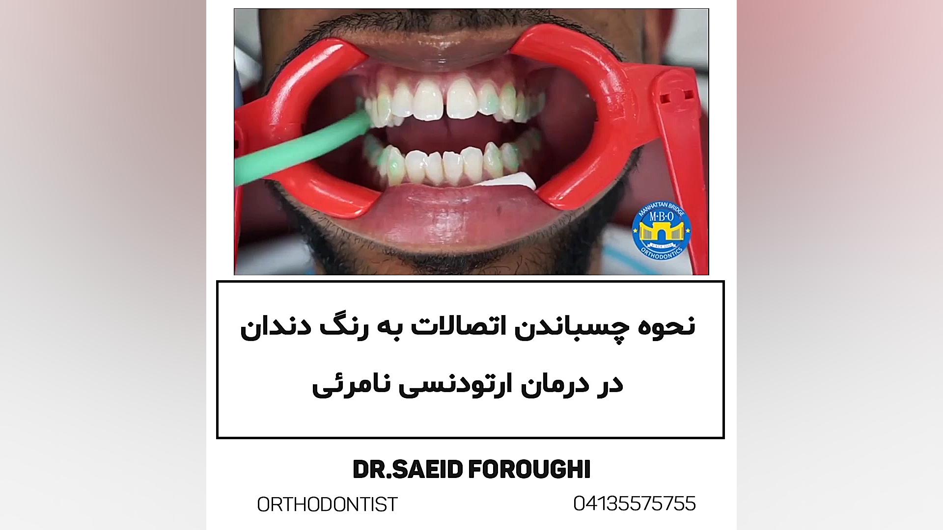 نحوه چسباندن اتصالات به رنگ دندان در درمان ارتودنسی نامرئی دکتر سعید فروغی متخصص ارتودنسی