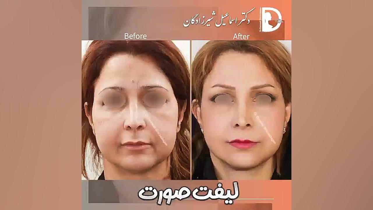 قبل و بعد از جراحی لیفت صورت دکتر اسماعیل شیرزادگان