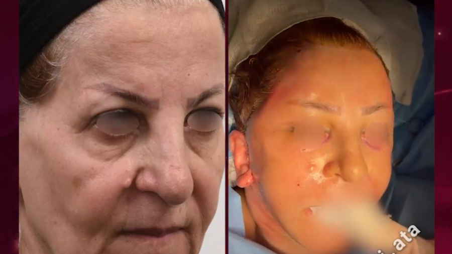 لیفت کامل صورت ، گردن و پیشانی تری‌متازیدین