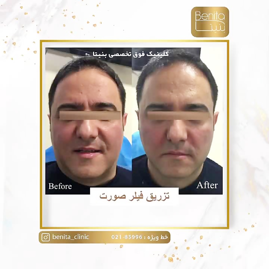 تزریق فیلر صورت