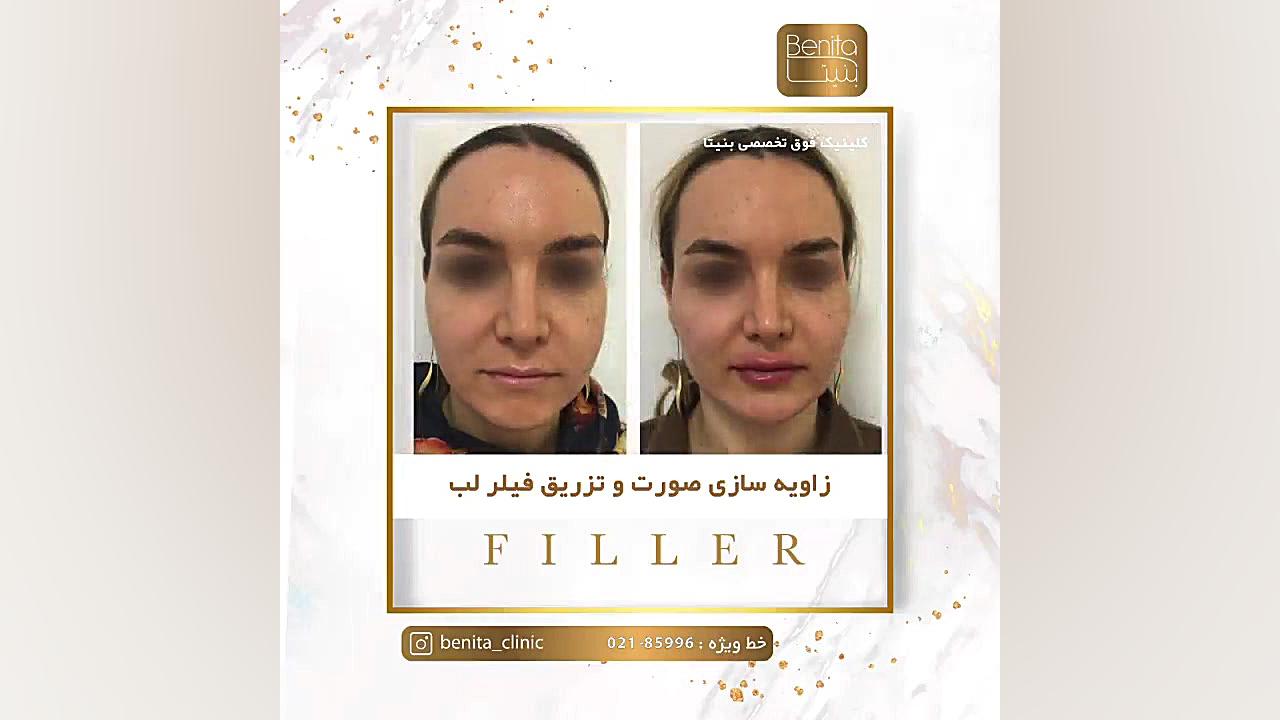 زاویه سازی صورت و تزریق فیلر لب باند ضد باکتری نانو