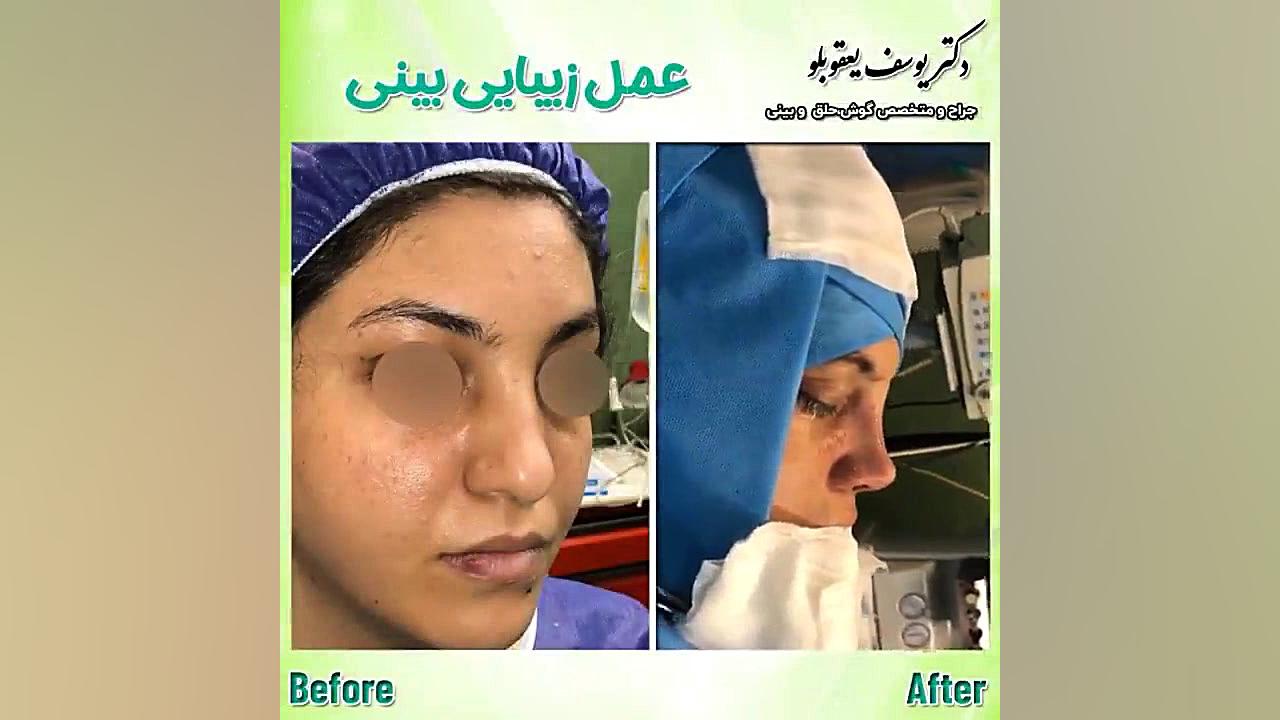 نمونه کارهای جراحی زیبایی بینی | جراحی بینی | دکتر یوسف یعقوبلو دیسمورفی فاسیال