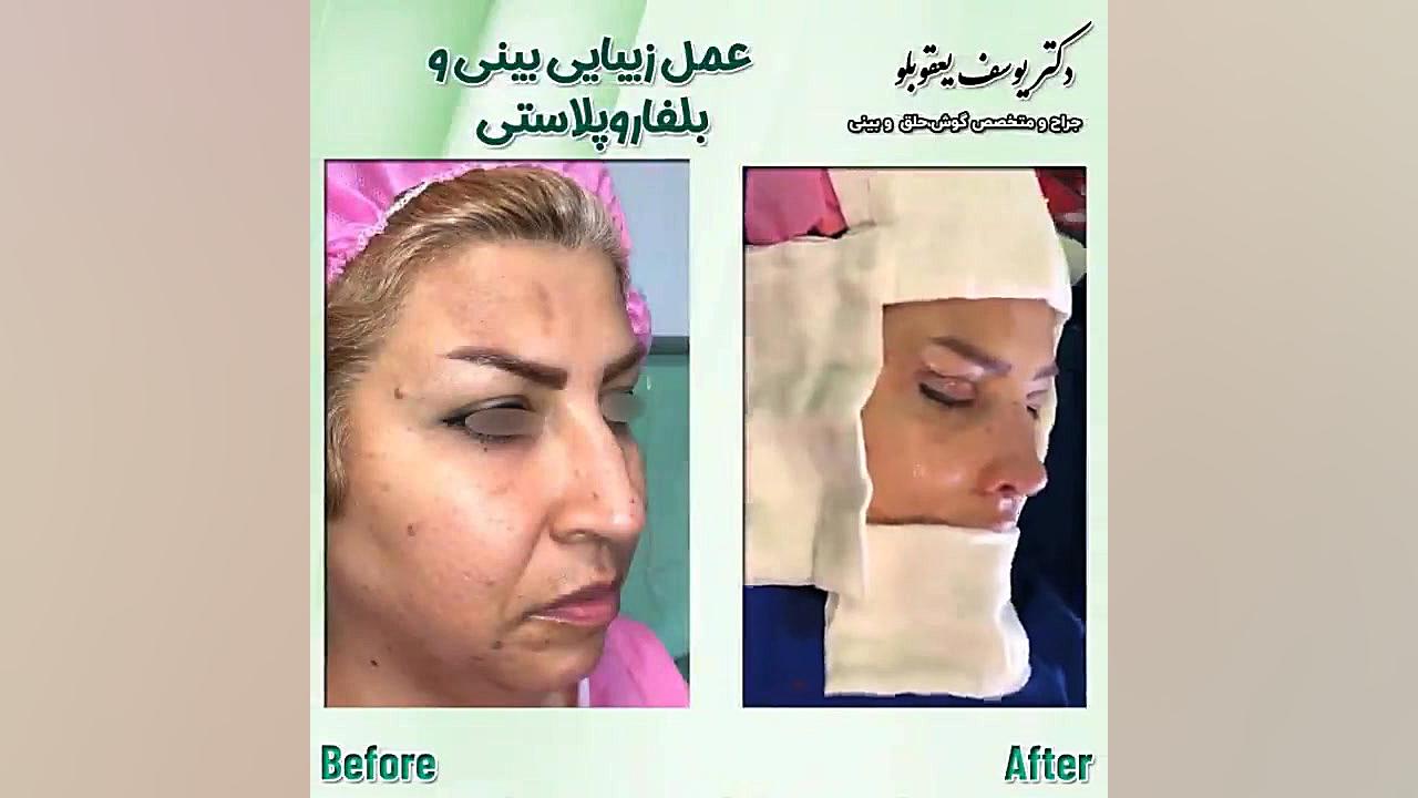 عمل زیبایی بینی | جراحی بینی | دکتر یوسف یعقوبلو پلاستیک لثه