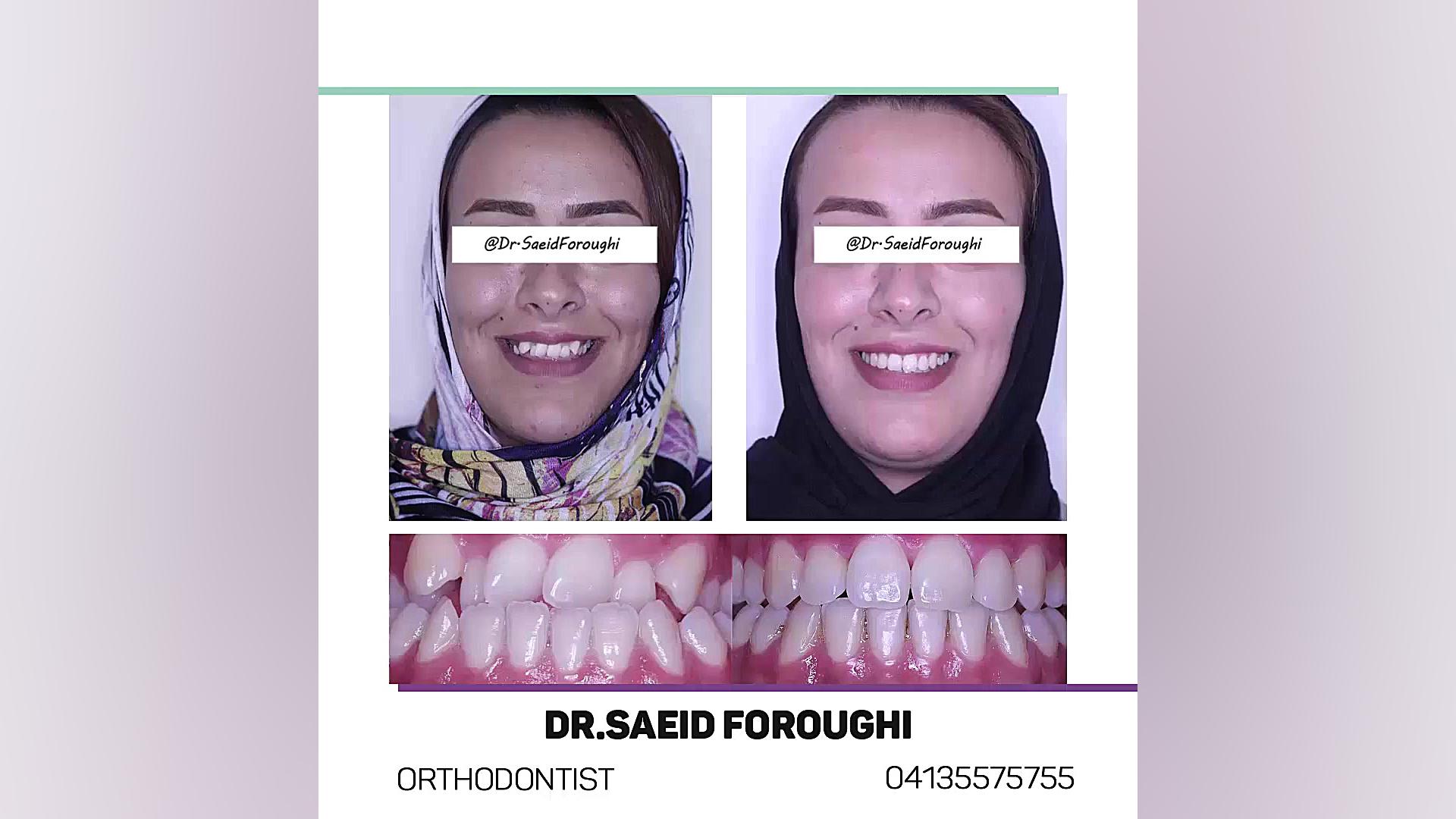 حل مشکل بی نظمی شدید دندانهای فک بالا دکتر سعید فروغی متخصص ارتودنسی