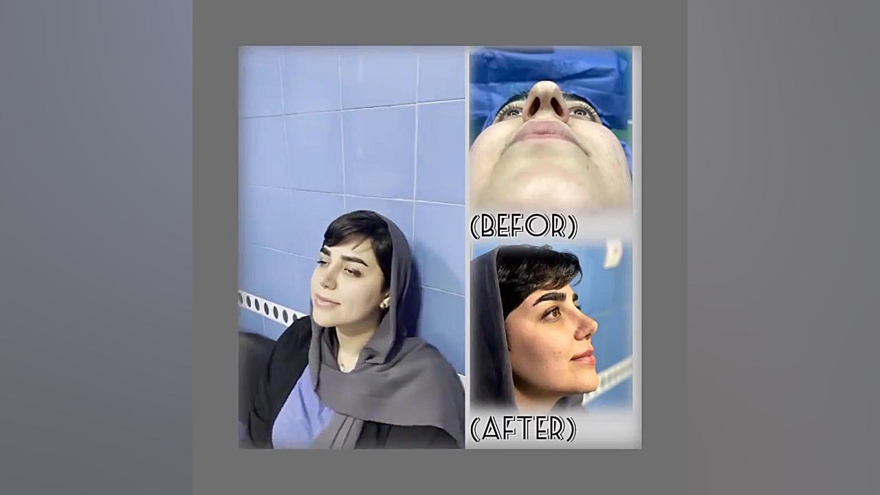 جراحی بینی دکتر امیر حسین محمدی مفرد دکتر امیر حسین محمدی مفرد