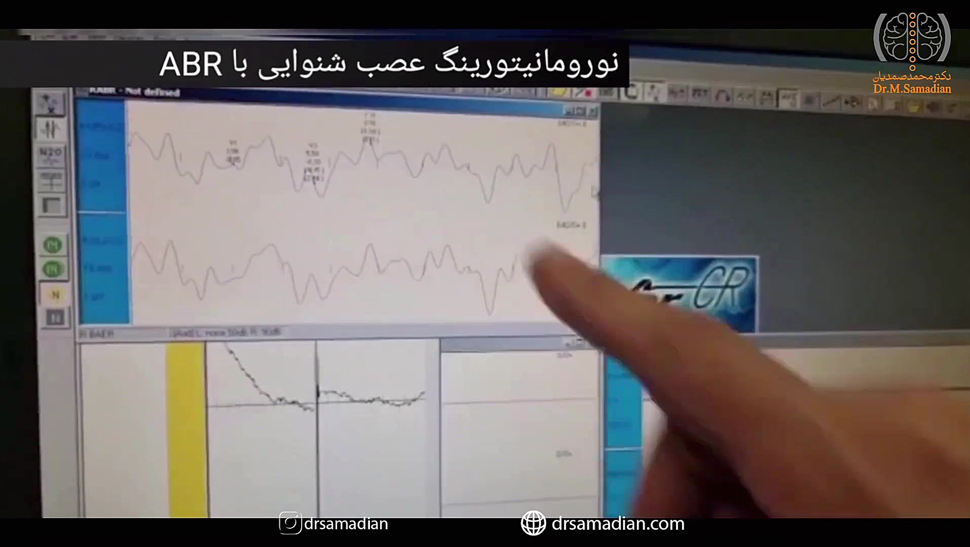 عمل جراحی رفع فشار بر روی عصب صورت برای درمان اسپاسم یک طرفه صورت رفع افتادگی پلک