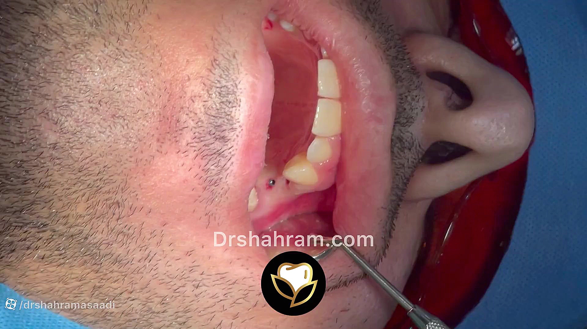 کاشت ایمپلنت بدون شکافتن لثه و بدون بخیه و بدون درد در یک نوبت جراحی پوشش زخم هیدروکلوییدی