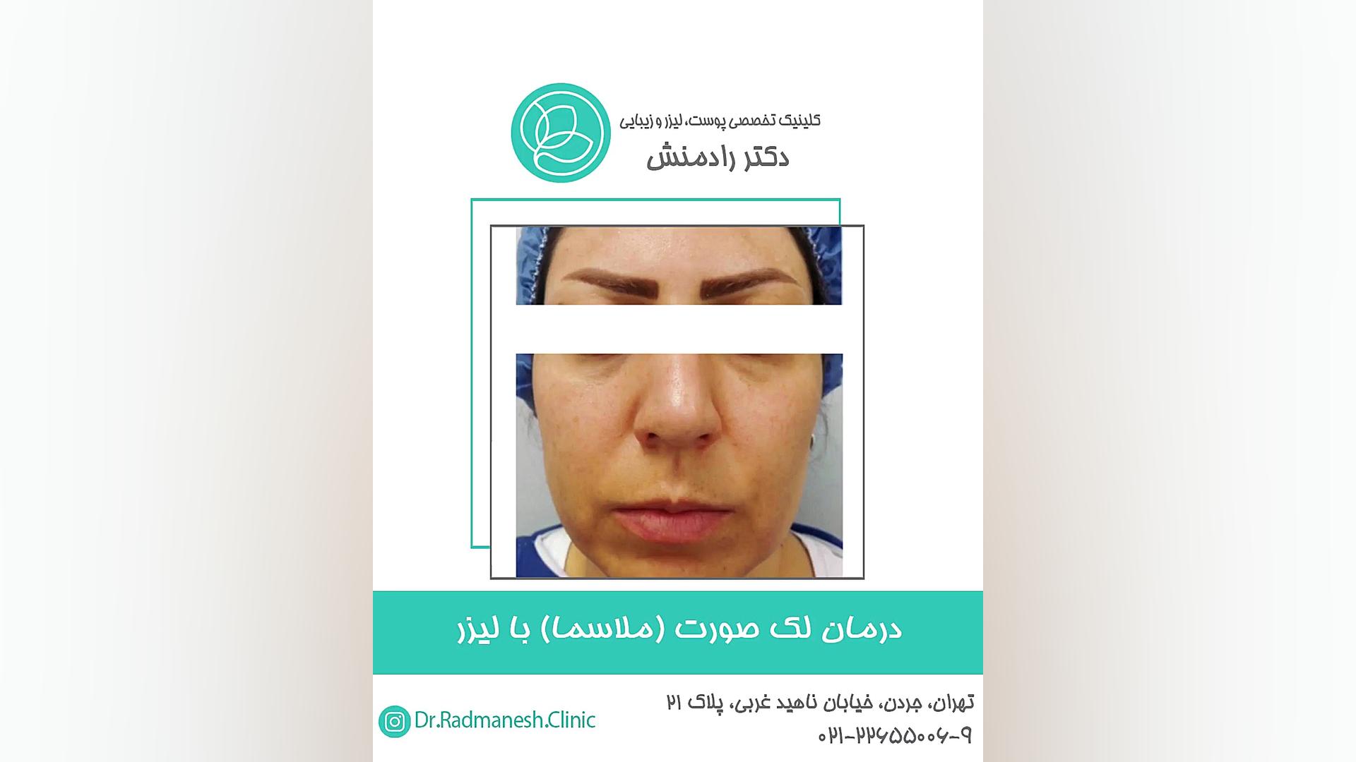 درمان لک صورت(ملاسما) با لیزر مزوتراپی