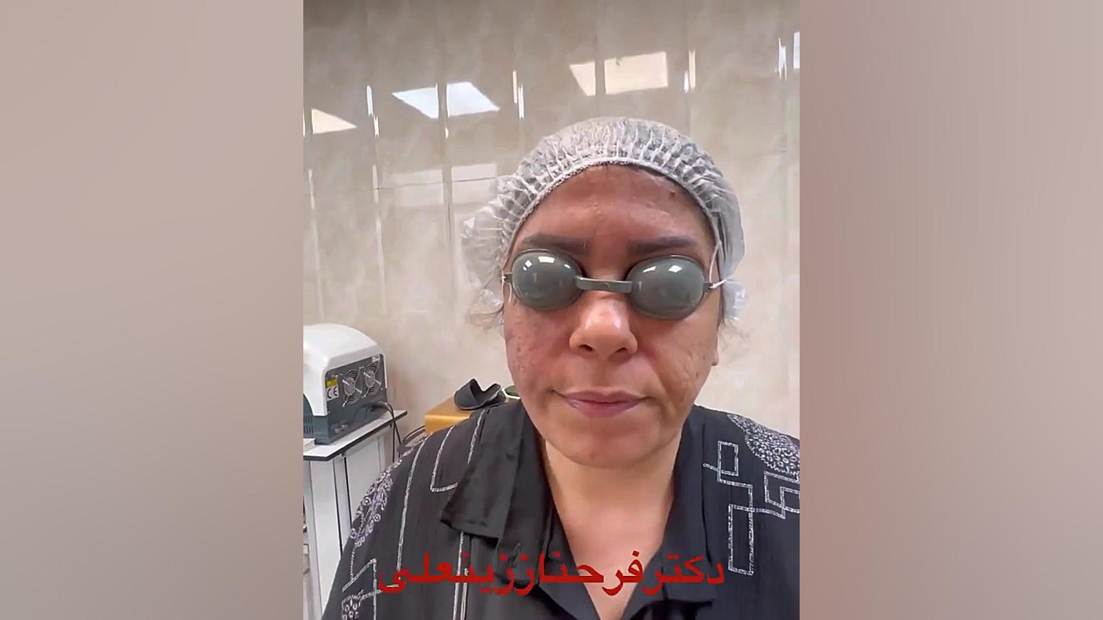 تاثیر بسیار عالی لیزر اندولیفت در ایجاد لیفت وجوانسازی صورت دکتر فرحناز زینعلی - متخصص پوست، مو، زیبایی زنجان