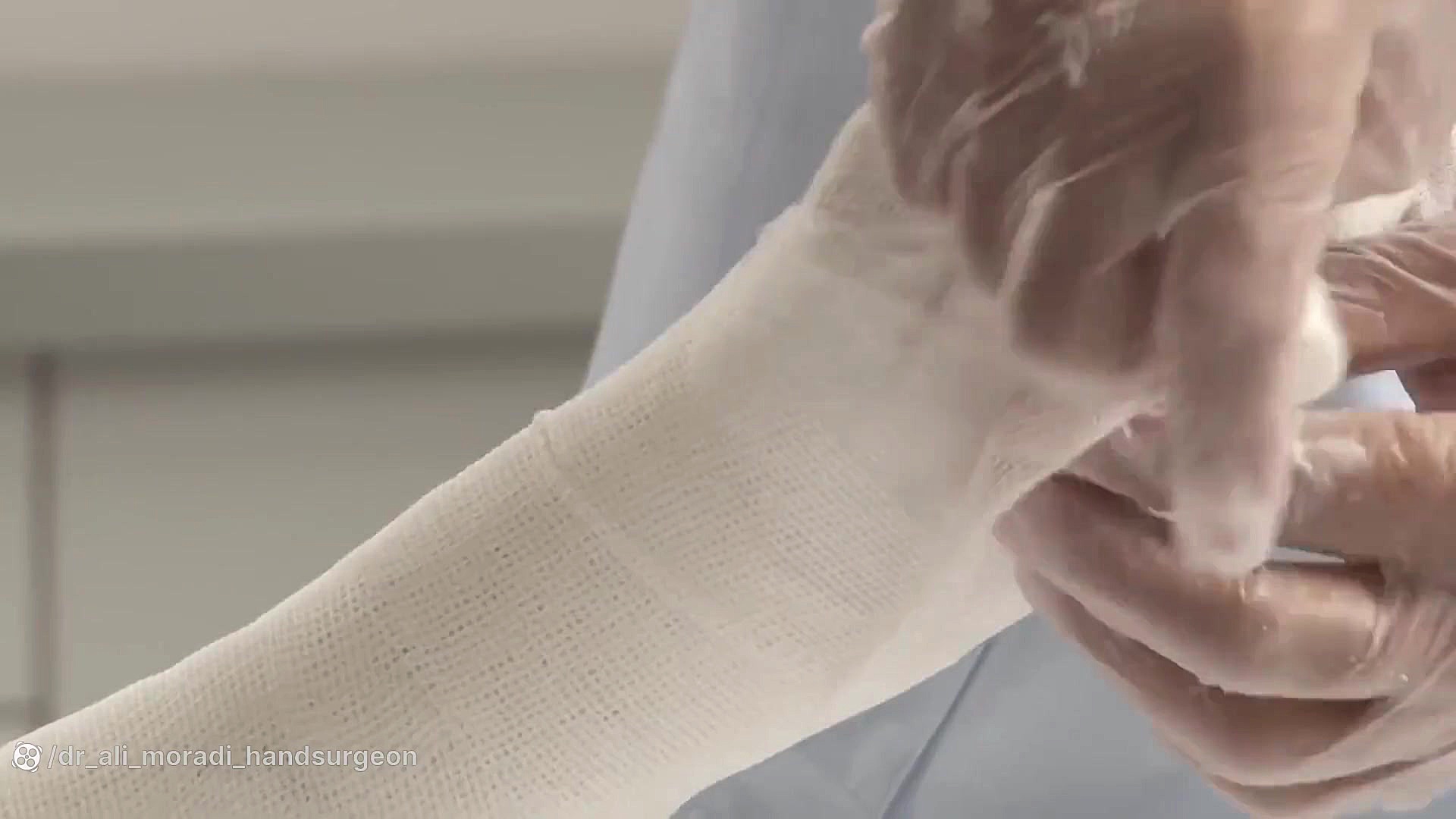 Hand Splint دکتر علی مرادی جراح دست