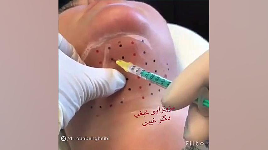 فیلم مزوتزاپی غبغب دکتر ربابه غیبی