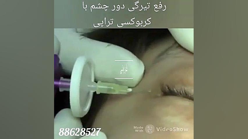 فیلم کربوکسی تراپی دور چشم دکتر ربابه غیبی