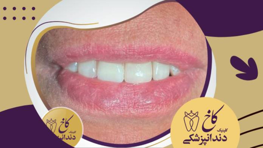 عفونت دندان کلینیک دندانپزشکی کاخ