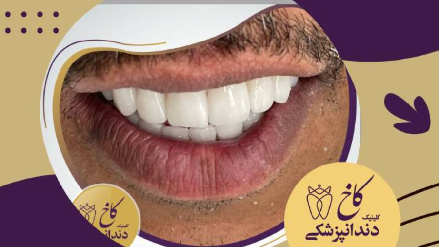 بازسازی یک لبخند زیبا! کلینیک دندانپزشکی کاخ