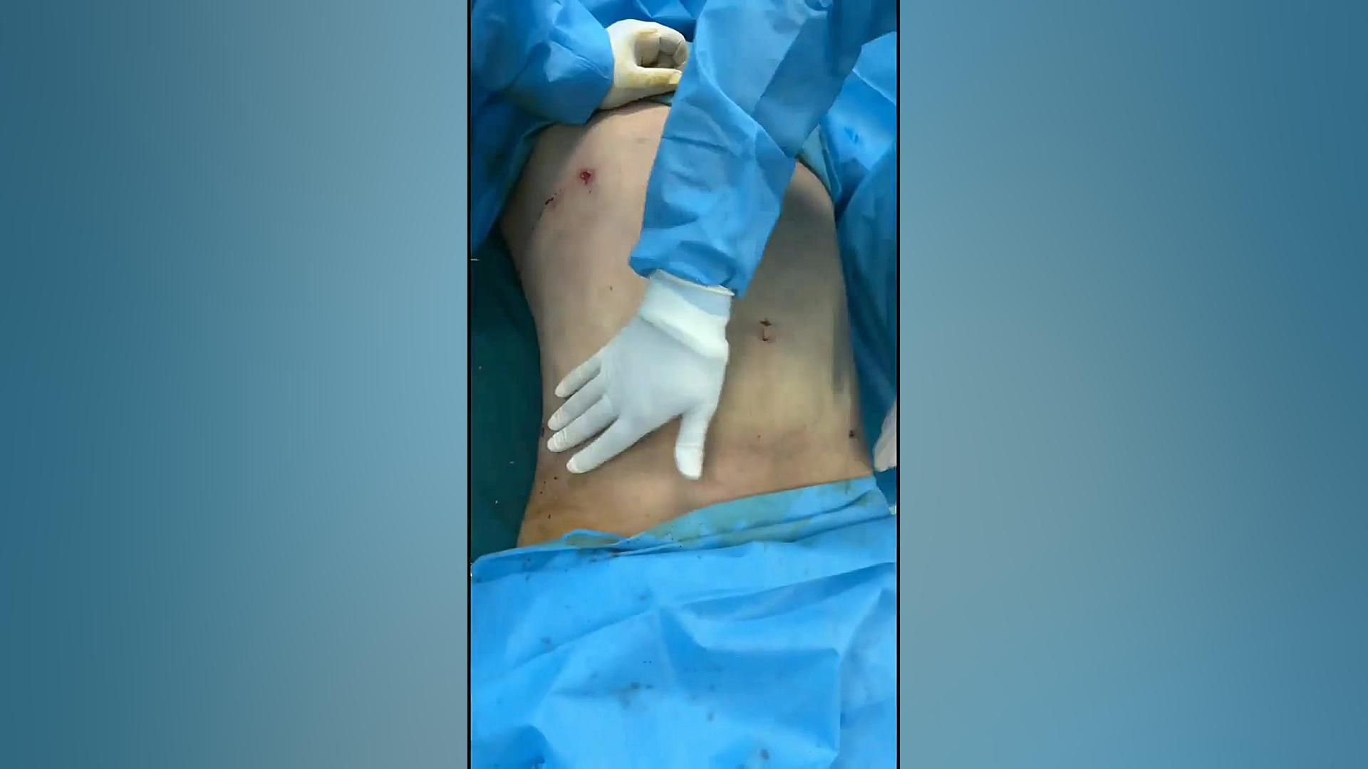 هزینه لیپوساکشن شکم و پهلو و توضیحات فوق تخصص جراحی پلاستیک-کلینیک vip علامت لاسگ