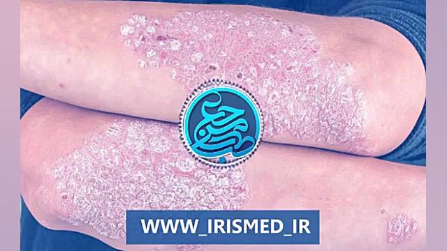 علت و درمان درمان پسوریازیس در طب سنتی/دکتر افراسیبیان لیپوست