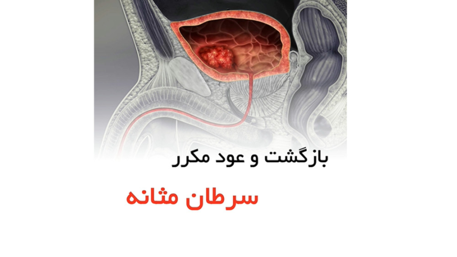 بازگشت و عود مکرر سرطان مثانه _ دکتر میرصادقی عصب‌کشی