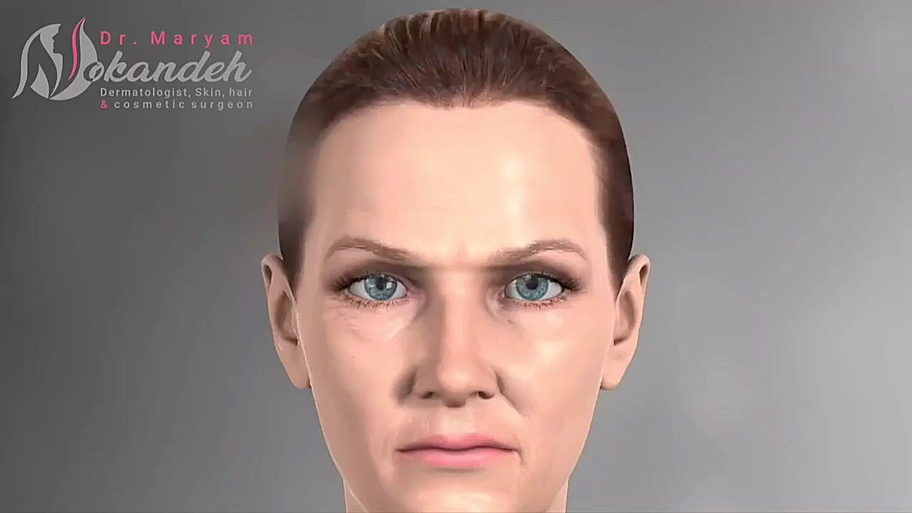 جراحی بلفاروپلاستی.... دکتر مریم نوکنده