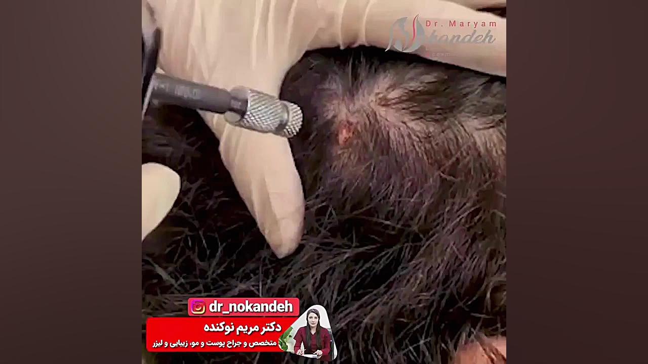 کرایوتراپی یا سرمادرمانی زگیل کف سر دکتر مریم نوکنده