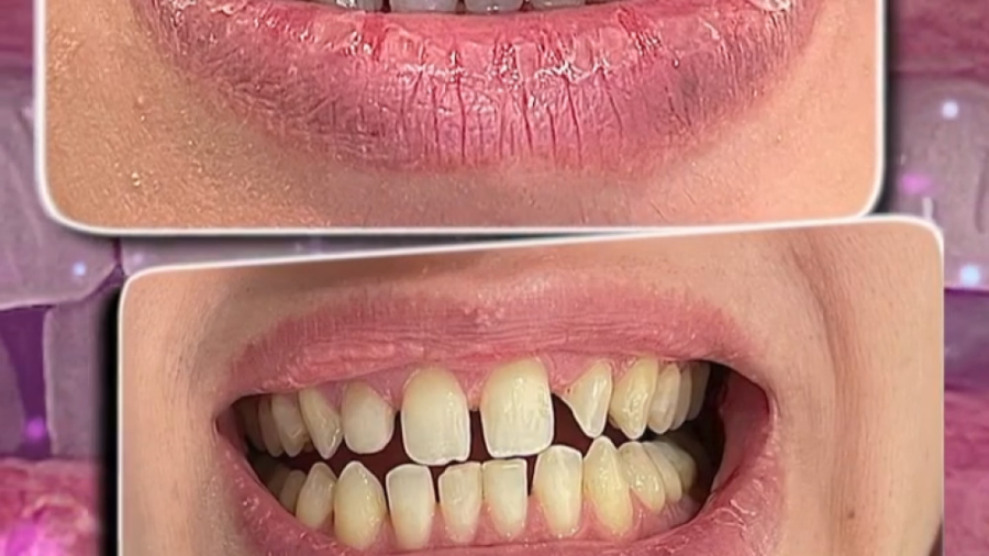 لمینیت سرامیک فک بالا - بدون تراش دندان - بلیچینگ فک پائین فورنزیک ژنتیک