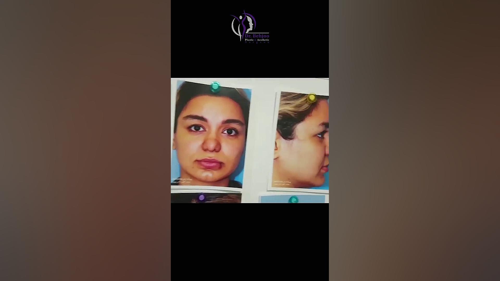 جراحی بینی نیمه فانتزی دکتر شاهین بهجو - فوق تخصص جراحی پلاستیک