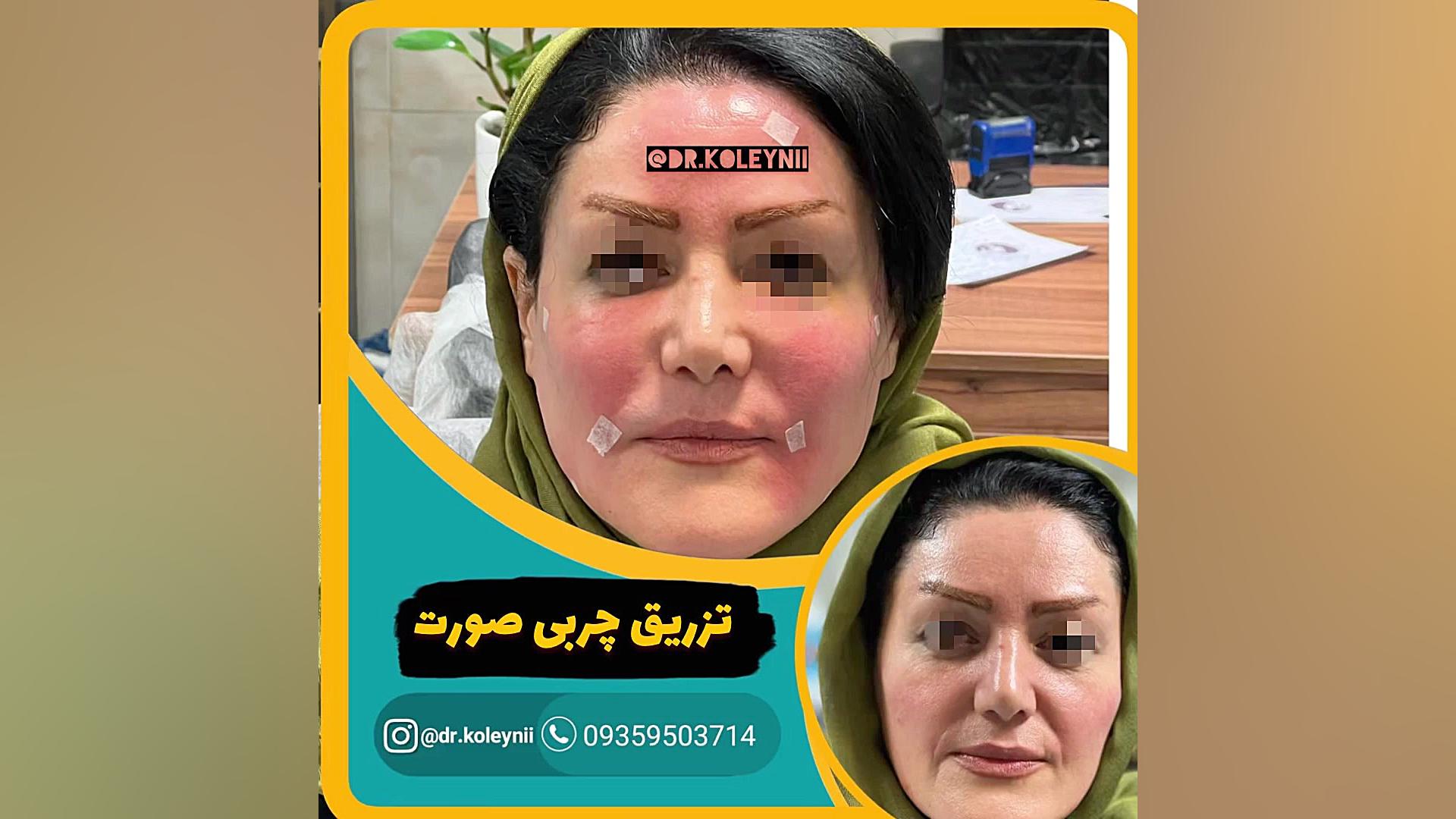 تزریق چربی نانوفت صورت توسط دکتر نعیم کلینی 09359503714 تست مهار دگزامتازون