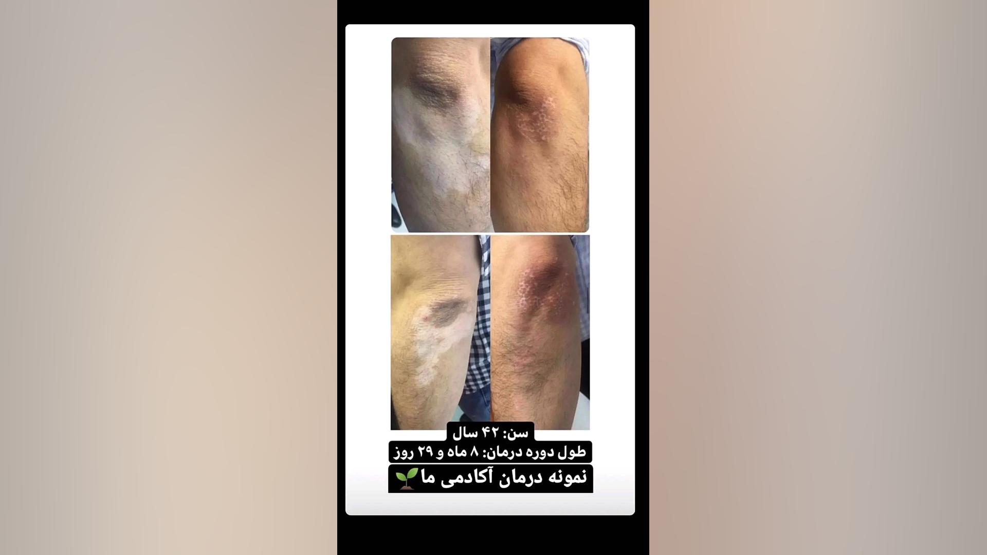 پیسی درمان داره؟ کلینیک مو