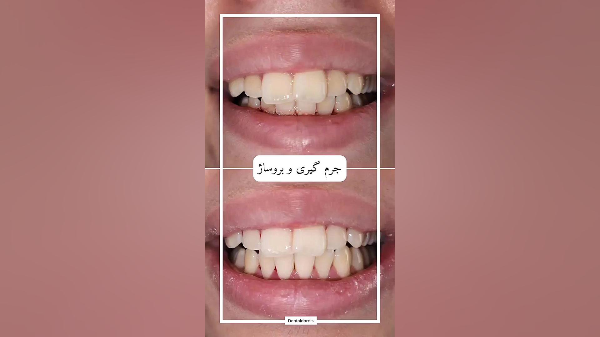 جرم گیری و بروساژ دندان تست تراشه ژنی