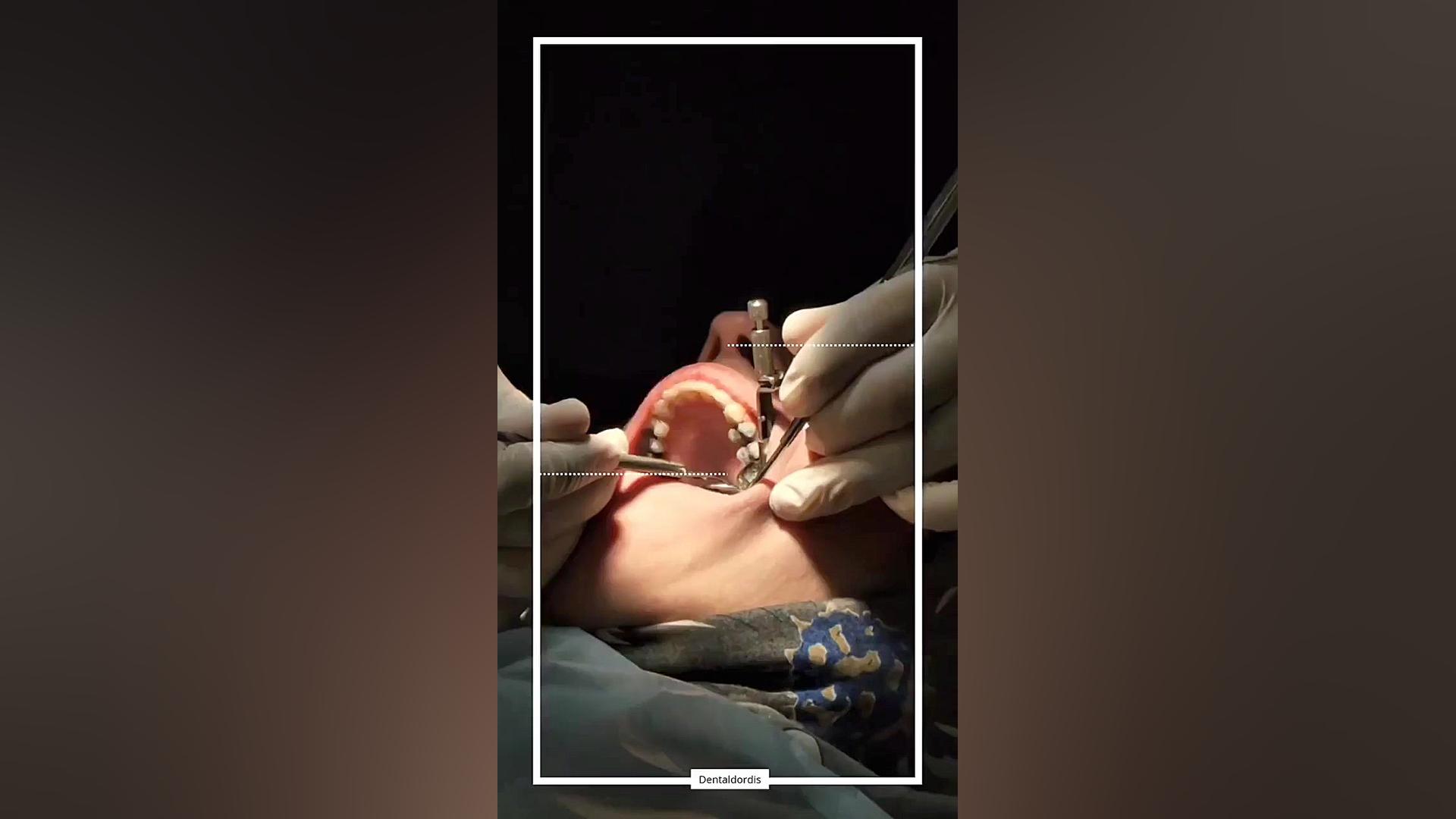 ترمیم آمالگام دندان لیپوست