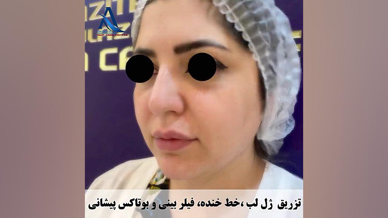 فیلم جالب از تزریق ژل لب، خط خنده، فیلر بینی و بوتاکس پیشانی زمان14ثانیه