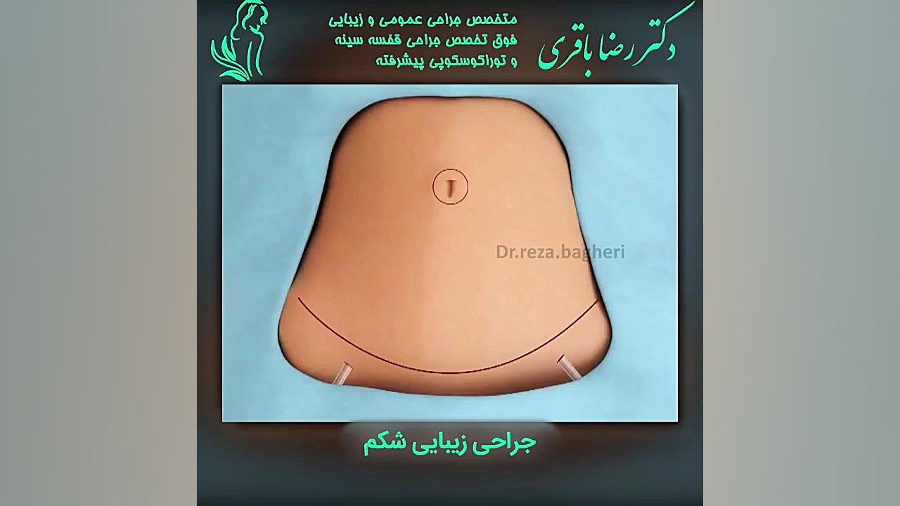 جراحی زیبایی شکم دکتر رضا باقری جراح سینه در مشهد