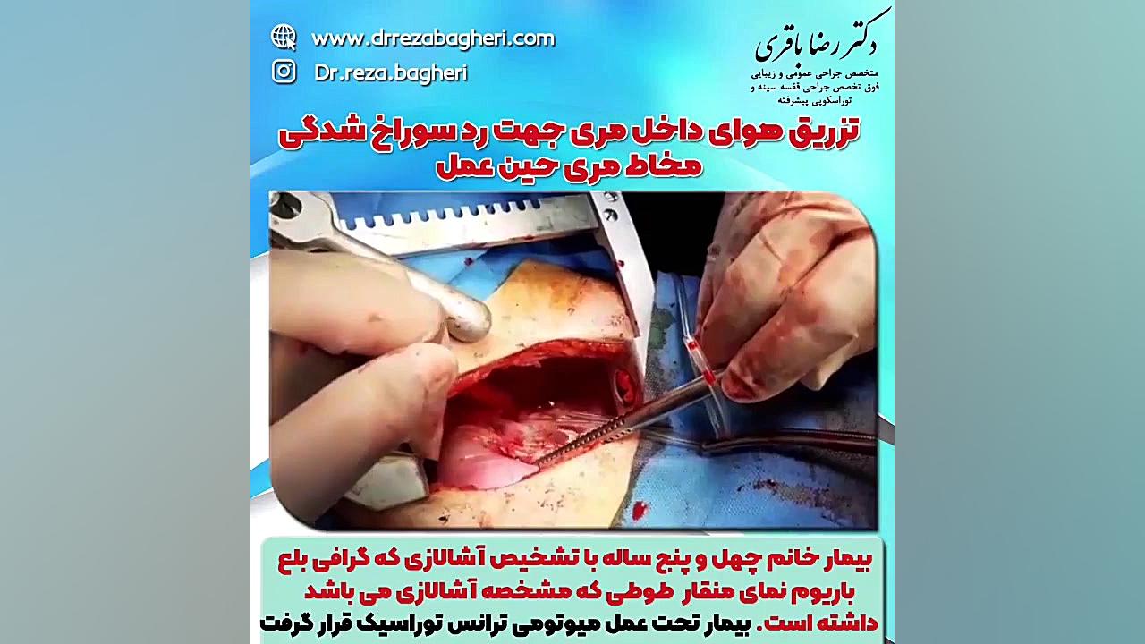 تزریق هوای داخل مری جهت رد سوراخ شدگی مخاط مری حین عمل دکتر رضا باقری جراح سینه در مشهد