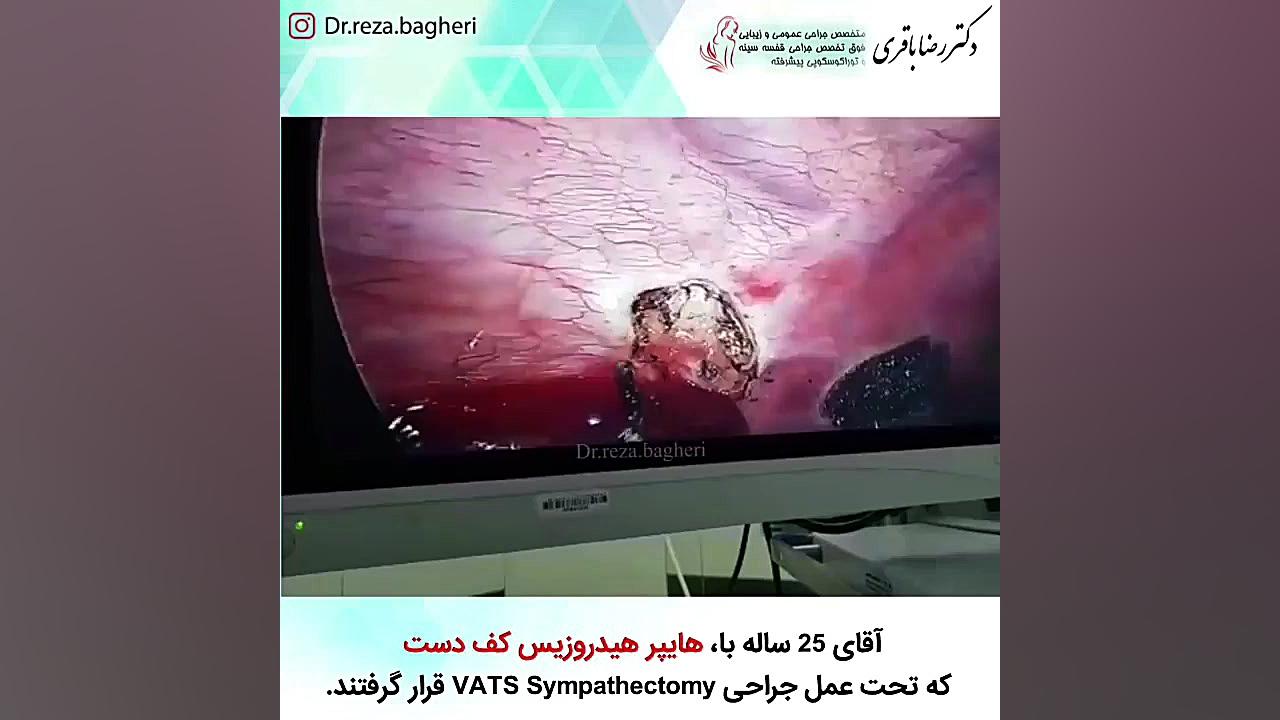 درمان آقای 25 ساله با هایپر هیدروزیس کف دست دکتر رضا باقری جراح سینه در مشهد